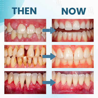 AEXZR® Makesmile Bee Venom Oral Treatment Powder